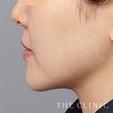 頰/顎のベイザー脂肪吸引のモニター(30代)術前症例画像