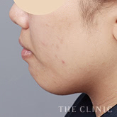 頰/顎のベイザー脂肪吸引のモニター(20代)術前症例画像