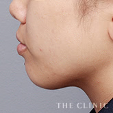 頰/顎のベイザー脂肪吸引のモニター(20代)術前症例画像