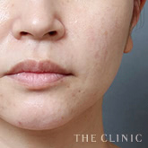 頰/顎のベイザー脂肪吸引のモニター(40代)術前症例画像