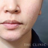 頰/顎のベイザー脂肪吸引のモニター(40代)術前症例画像