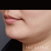 頰/顎のベイザー脂肪吸引+レヌビオンのモニター(40代)術前症例画像