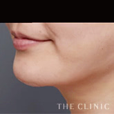 頰/顎のベイザー脂肪吸引+レヌビオンのモニター(40代)術前症例画像