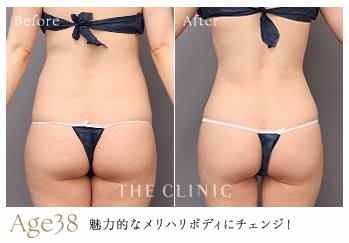 38歳女性がくびれ脂肪吸引で魅力的なメリハリボディにチェンジした症例