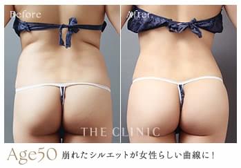 50歳女性の崩れたシルエットが女性らしい曲線になったくびれ脂肪吸引の症例