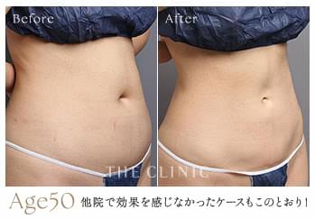 他院の脂肪吸引で効果を感じなかった50歳女性のくびれ脂肪吸引の症例