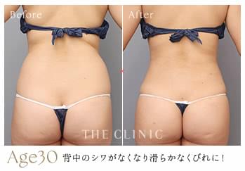 くびれ脂肪吸引で背中のシワがなくなり滑らかなウエストラインになった30歳女性の症例