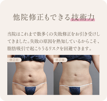 他院修正もできる技術力 | 当院はこれまで数多くの失敗修正をお引き受けしてきました。失敗の原因を熟知しているからこそ、脂肪吸引で起こりうるリスクを回避できます。