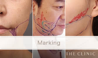 顔(頬・顎下)脂肪吸引時の実際のマーキング