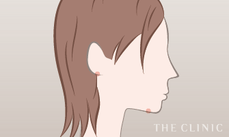 頬・顎下の脂肪吸引の傷跡位置