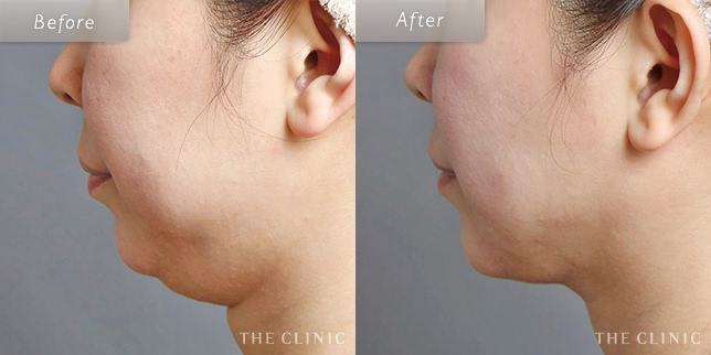 顔(頬・顎下)脂肪吸引の39歳女性の症例写真