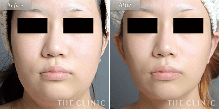 顔（頬・顎下）ベイザー脂肪吸引を受けた23歳女性の症例写真