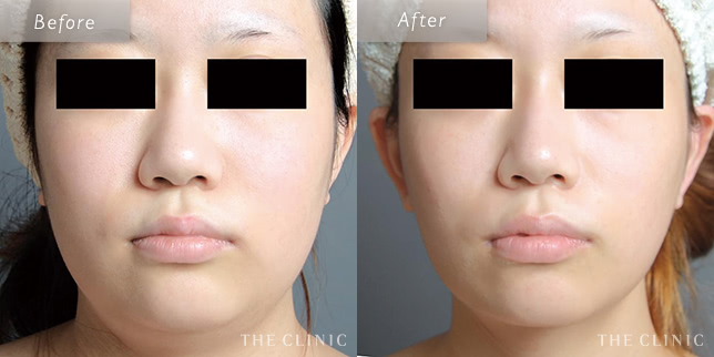 顔(頬・顎下)ベイザー脂肪吸引を受けた23歳女性の症例写真