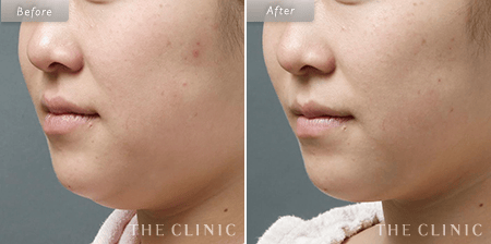 顔（頬・顎下）脂肪吸引の23歳女性の症例写真