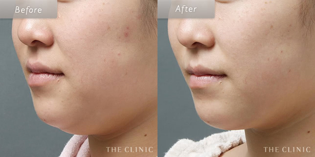 顔(頬・顎下)脂肪吸引の23歳女性の症例写真