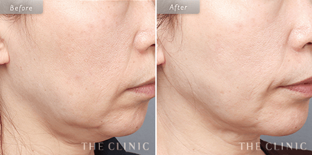 顔（頬・顎下）脂肪吸引の53歳女性の症例写真