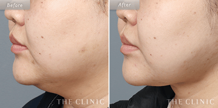 顔（頬）の脂肪吸引を受けた25歳女性の症例写真