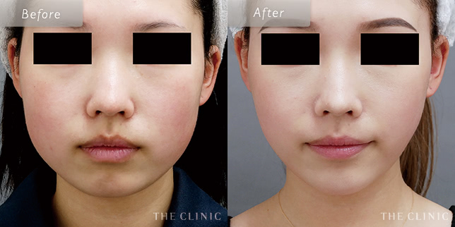 顔(頬)の脂肪吸引を受けた23歳女性の症例写真