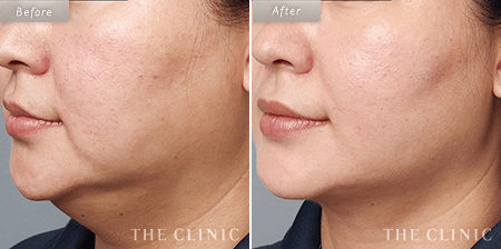 顔（頬・顎下）脂肪吸引を受けた35歳女性の症例写真