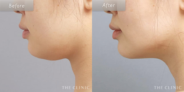 顔(頬・顎下)脂肪吸引を受けた40歳女性の症例写真