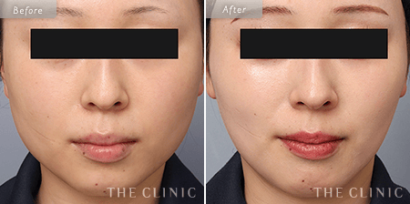 顔（頬・顎下）脂肪吸引を受けた21歳女性の症例写真