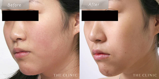 顔(頬・顎下)脂肪吸引を受けた25歳女性の症例写真