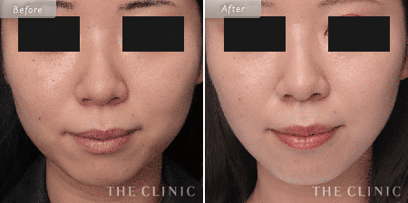 顔（頬・顎下）脂肪吸引を受けた44歳女性の症例写真