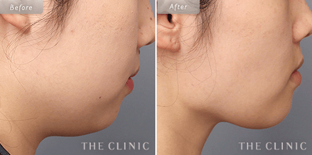 顔（頬・顎下）脂肪吸引を受けた28歳女性の症例写真