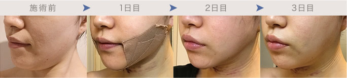 頬・顎下の脂肪吸引1~3日後のダウンタイム経過写真