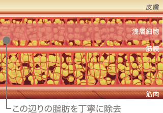 この辺りの脂肪を丁寧に除去