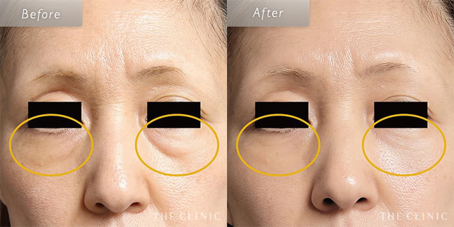 目の下のたるみ取り・クマ取りの50歳女性の症例写真