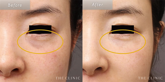 目の下のたるみ取り・クマ取りの33歳女性の症例写真