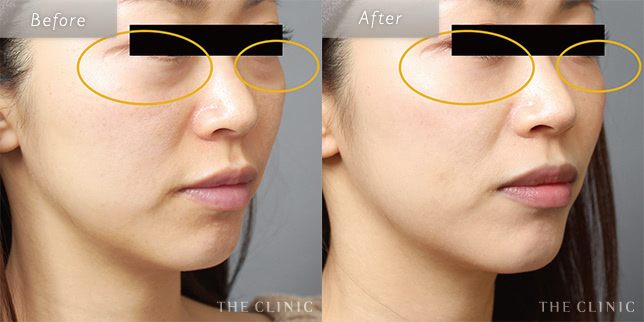 目の下のたるみ取り・クマ取りの30歳女性の症例写真