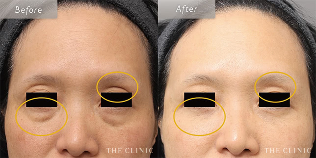 目の下のたるみ取り・クマ取りの53歳女性の症例写真