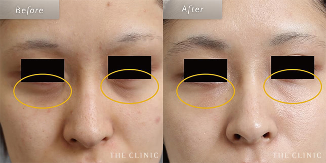 目の下のたるみ取り・クマ取りの22歳女性の症例写真