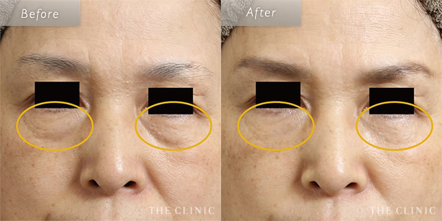 目の下のたるみ取り・クマ取りの58歳女性の症例写真