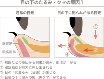 目の下のたるみ・クマの原因１