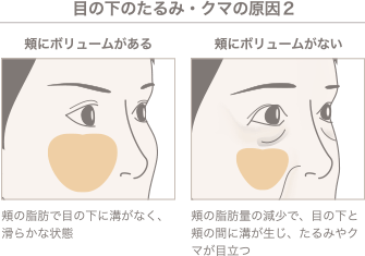 目の下のたるみ・クマの原因2