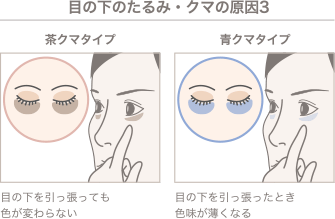 目の下のたるみ・クマの原因3