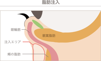 脂肪注入