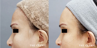 失った脂肪を補って、窪んだおでこを丸く若々しい額に改善した症例