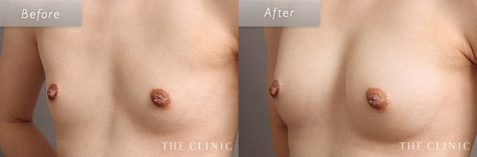 漏斗胸の(コンデンスリッチ豊胸)の症例画像1