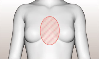 漏斗胸は、胸の中央部がくぼみ変形してしまう病気。一般的に自然治癒することはなく、成長とともに胸部がさらにくぼんだり、左右非対称になったりすると考えられています。