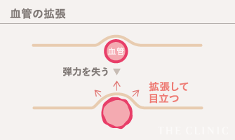 血管の拡張：血管自体の弾力が老化により失われていくことで、血管が拡張して目立つようになります