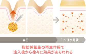 脂肪幹細胞の再生作用で注入後から徐々に効果があらわれる