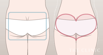 脂肪吸引の進め方1