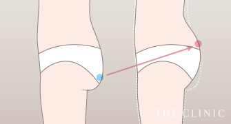 脂肪吸引の進め方2