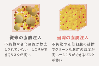 従来の脂肪注入: 不純物や老化細胞が除去しきれていない​​＝しこりができるリスクが高い / 当院の脂肪注入: 不純物や老化細胞の排除でクリーンな脂肪の密度が高い​​＝しこりができるリスクが低い