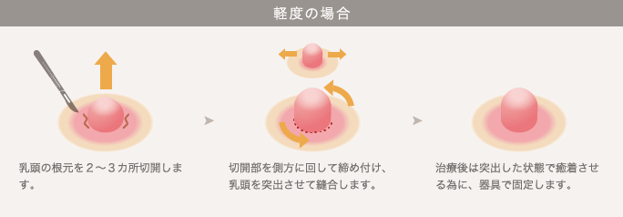 軽度の場合: 1. 乳頭の根元を２〜３カ所切開します。 / 2. 切開部を側方に回して締め付け、乳頭を突出させて縫合します。 / 3. 治療後は突出した状態で癒着させる為に、器具で固定します。