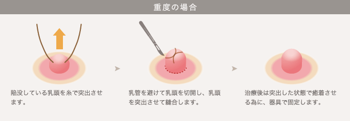 重度の場合: 1. 陥没している乳頭を糸で突出させます。 / 2. 乳管を避けて乳頭を切開し、乳頭を突出させて縫合します。 / 3. 治療後は突出した状態で癒着させる為に、器具で固定します。
